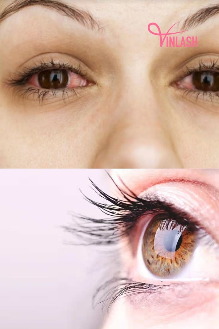 What is Eyelash Extension Irritation?