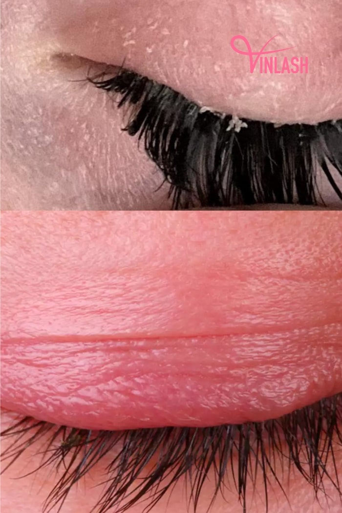 What Causes Eyelash Extensions Itchy?