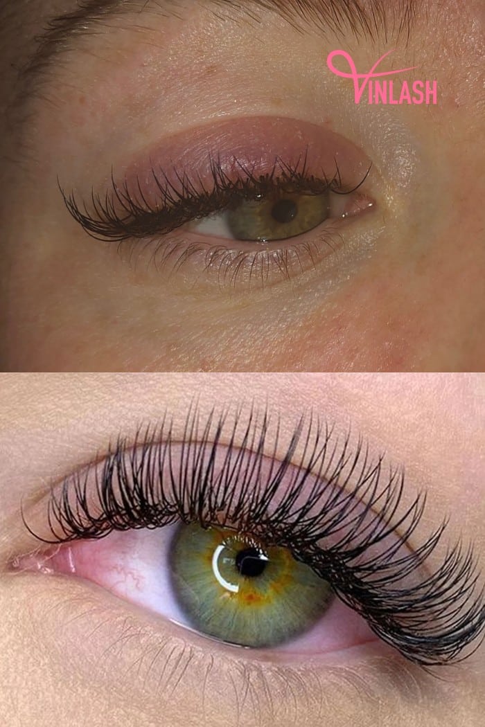 What is Eyelash Extension Allergy?