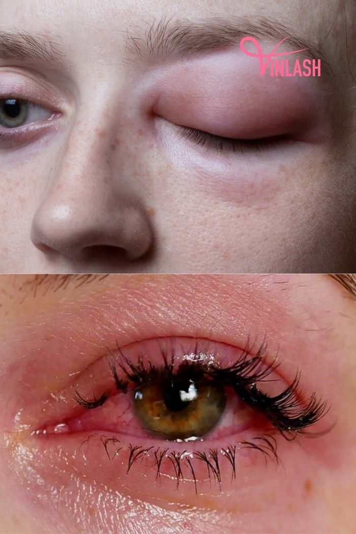 Comparing Eyelash Extension Allergy vs Irritation