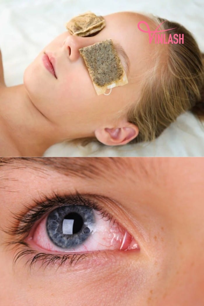 Treatment Strategies for Bloodshot Eyes After Lash Extensions